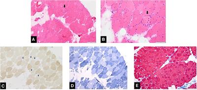 Case Report: Severe vitamin D deficiency in a girl with inflammatory myopathy and myonecrosis